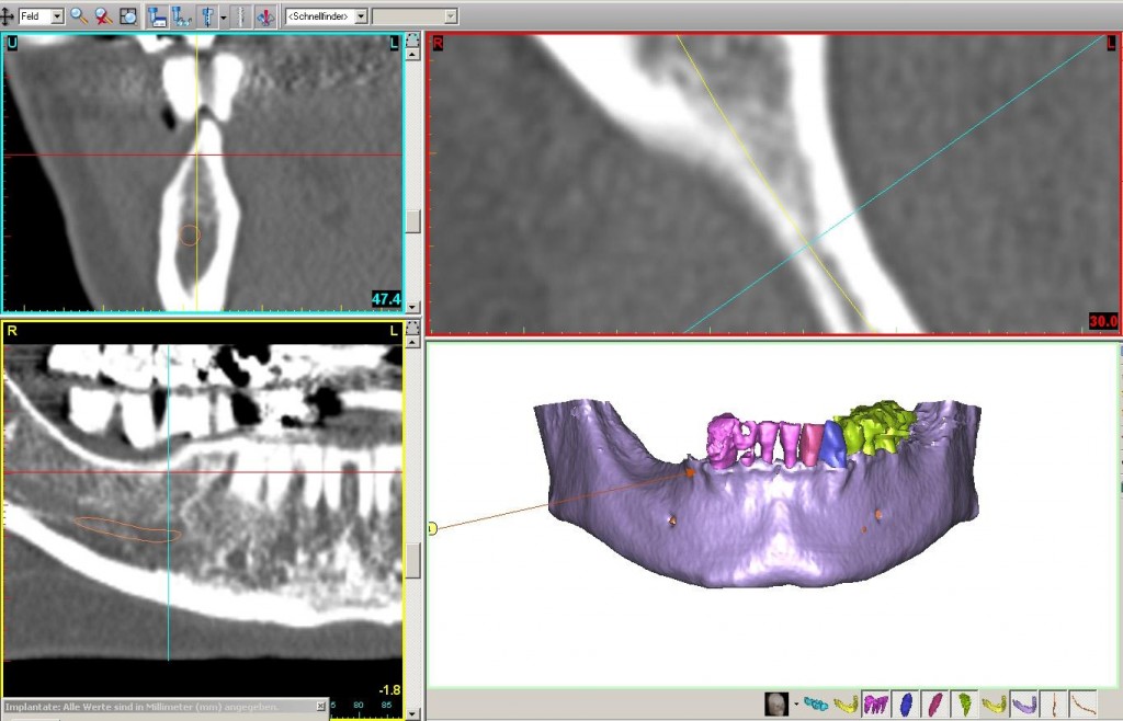 TF_Mintert_3DZahnimplantat_1 Lage des Implantats
